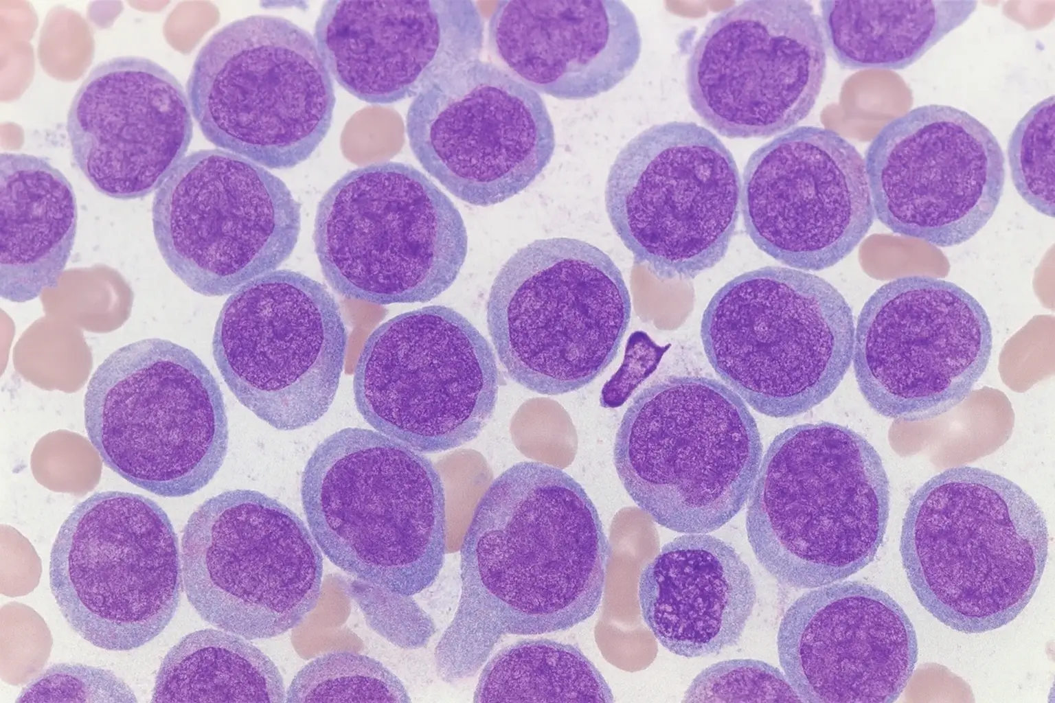 Revuforj recebe aprovação da FDA para tratar leucemia mieloide aguda