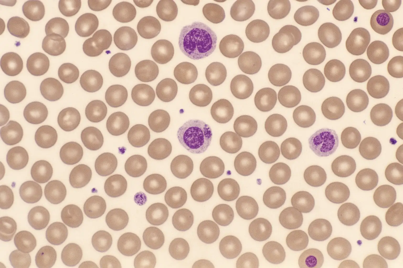 Ropeginterferon alfa-2b mostra eficácia inédita na trombocitemia essencial