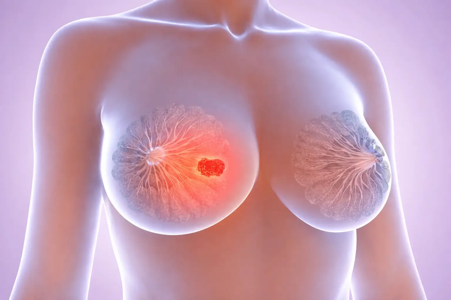 Gedatolisibe amplia a sobrevida livre de progressão no câncer de mama avançado