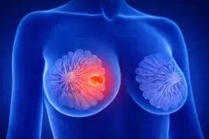 Anvisa aprova ribociclibe para reduzir recidiva do câncer de mama RH+/HER2-