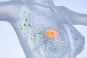 Ibrance amplia sobrevida livre de progressão no câncer de mama metastático duplo-positivo