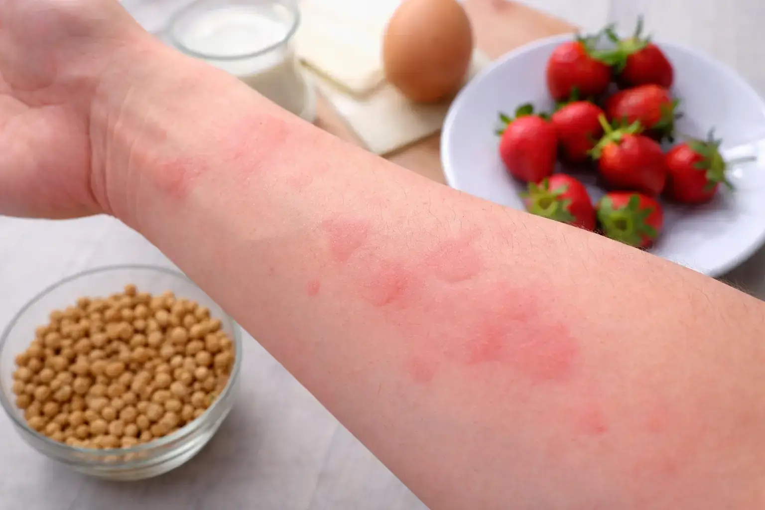 Medicamento para asma mostra potencial para reduzir reações a alergias alimentares