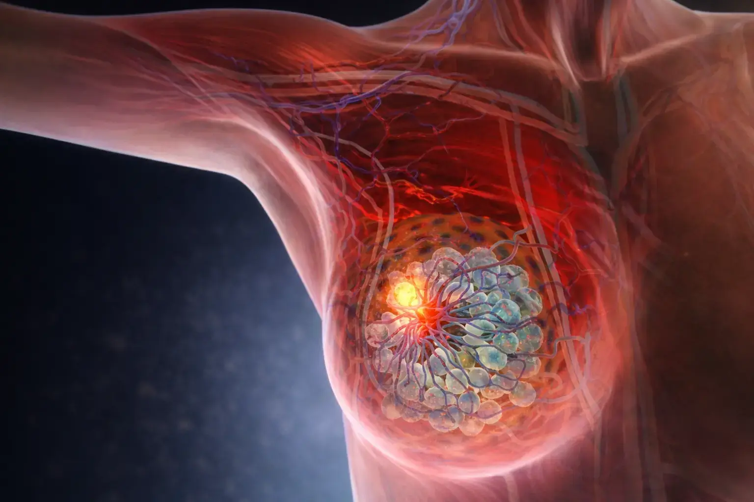 FDA aprova combinação com Enhertu para câncer de mama HER2-positivo metastático