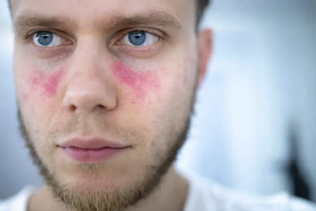 Anticorpo anti-BDCA2 mostra redução da artrite em estudo de fase 2 no lúpus