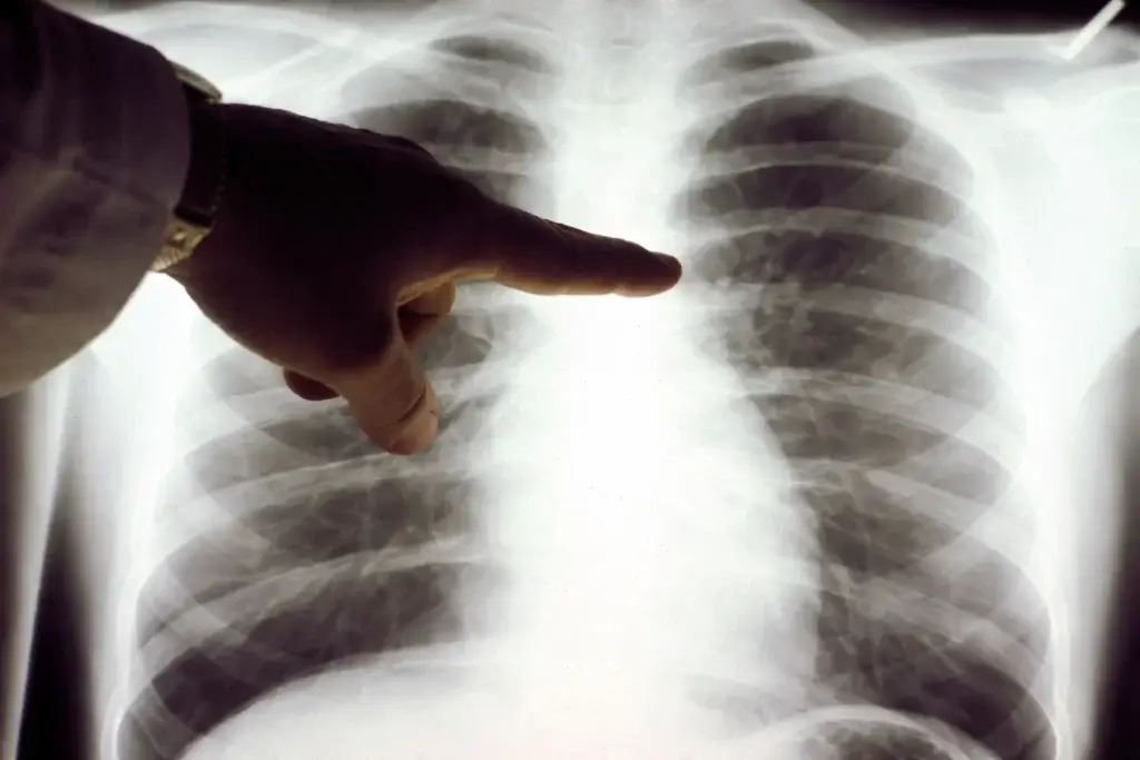 FDA Aprova primeiro medicamento contra o câncer baseado em pesquisa do Broad Institute